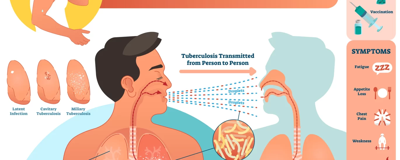 tuberculosis
