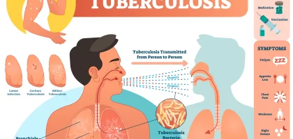 tuberculosis