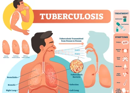 tuberculosis